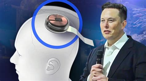 rfid brain chip by 2017|Elon Musk's Neuralink Has Implanted Its First Chip in a Human .